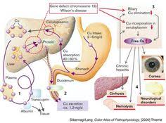 Wilsons Disease