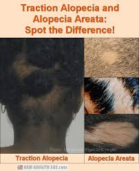 Well, dear wearers of ball caps and bowlers, rest assured: Friction Alopecia Does Wearing A Hard Hat Cause Baldness Traction Alopecia Alopecia Traction Alopecia Treatment