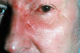 Some people also develop pain, itching, tingling, and burning on the skin before the rash appears. Shingles Signs And Symptoms