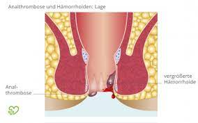 Проверьте 'knoten' перевод на английский. Analthrombose Analvenenthrombose Symptome Ursachen Behandlung Onmeda De