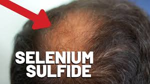 I have noticed that some clip bait websites have posted warnings that some shampoo products will cause extreme hair loss and potential. Selenium Sulfide And Hair Loss Is There A Connection Hairguard