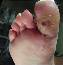 Can vitamin deficiency, skin fungus and exposure to sun result in white spots, dots or patches on face? When Vitamin And Nutritional Deficiencies Cause Skin And Nail Changes Podiatry Today
