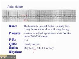 Ecg Atrial Flutter Atrial Flutter Cardiac Nursing Medical Studies