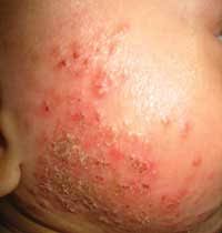 Itchiness accompanied by a skin condition or any other abnormality should be use myrrh if you're suffering from eczema or a fungal infection. 5 Allergy And The Skin Eczema And Chronic Urticaria The Medical Journal Of Australia