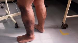 Image result for Pigment stains on the shin