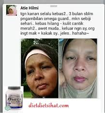 Juga mengalami kaki kebas, kaki kebas terus menerus, seperti kaki kebas kesemutan. Set Kebas Tangan Shaklee Pengedar Shaklee Shah Alam