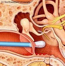Conditions that produce a lot of dry, flaking skin, like eczema, can also result in hard earwax. Ear Wax
