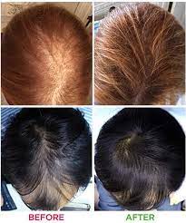 Hair loss can be cured naturally with the above listed homemade therapies. What Are The Best Hair Products Reviews For Hair Growth Hair Growth System Hair Laser Growth Hair Loss Treatment