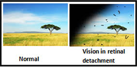 It is extremely important that a retinal tear gets treated in time. Welcome To Kumta Clinic