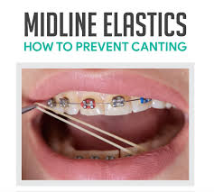 What Orthodontic Issues Can'T Invisalign Fix? Helotes Dentist