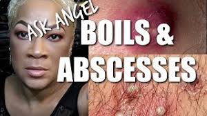 When should someone seek medical attention for a boil? How To Get Rid Of Boils On Private Area