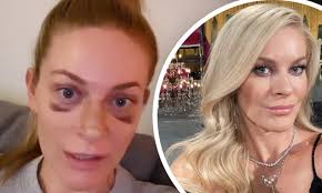 Amid reports of ryan giggs' arrest for an alleged assault on his girlfriend, people want to know more about her. Rhony S Leah Mcsweeney Proudly Reveals Bruises From A Nose Job I Am Not Trying To Hide Anything