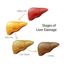 How long can you live with liver failure. Liver Disease Symptoms Causes Treatment Narayana Health
