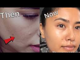 How to get rid of textured skin overnight. How To Get Rid Of Tiny Bumps On Face Clear Smooth Skin Secrets Beautynepal Youtube