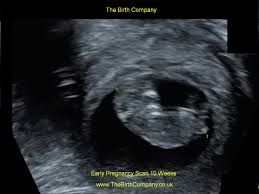 Dating/viability scan establishing an estimated due date early on in pregnancy is of vital importance, as this date is then used for the rest of the pregnancy to determine when the baby is likely be born. Early Pregnancy Scan 120 Viability Scan In London The Birth Company
