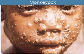 While officials say that the risk is low due to the air. Monkeypox Nurses Zone Source Of Resources For Nurses