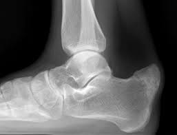 Haglund's deformity is a bony enlargement on the back of the heel. Osteochondroma Of The Calcaneus Presenting As Haglund S Deformity Sciencedirect