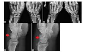 Front Back Reconstruction For Scapholunate Dissociation Restores Normal Alignment