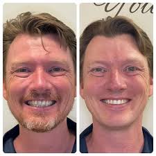 Smile Makeover Gallery Van Nuys, CA