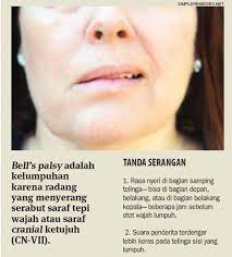 It begins suddenly and can get worse over 48 hours. Kenali Gejala Penyakit Bells Palsy Agar Cepat Mendapat Bantuan Cantik Tempo Co