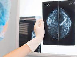 In 2021, libras are going to be moderately healthy. Asco 2021 This Olympia S Looking Good Lynparza Succeeds In High Risk Early Stage Breast Cancer 2021 06 04 Bioworld