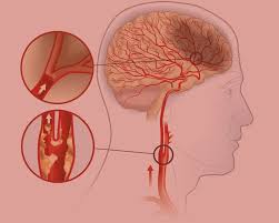 Image result for carotid artery