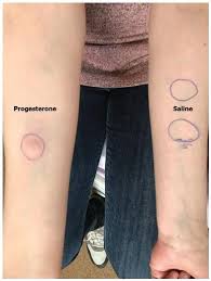 Scielo Brasil Autoimmune Progesterone Dermatitis A Case Report Autoimmune Progesterone Dermatitis A Case Report
