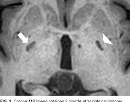 Image result for Pallidotomy