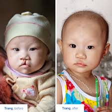 Custom doll for baby girl with cleft lip