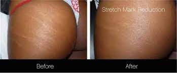 Scars And Stretch Mark Ahvia Beauty And Wellness Facebook