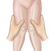 Genu Valgum (knocked knees) - Pediatrics - Orthobullets