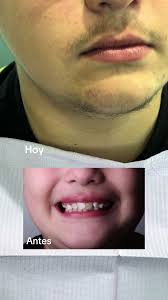 Hace 7 meses retiramos los brackets. Hoy vino a consulta de revisión de  retención #Ortodoncia #Ortodoncista #tijuana #TijuanaOrtodoncia  #TijuanaBraces #Dentista