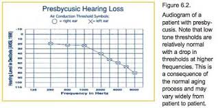 Audiometry And Hearing Disorders Hear1002 Flashcards Quizlet