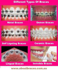 How much does braces cost in maryland. Different Types Of Braces Philbin Reinheimer Orthodontics In Annapolis Maryland And Stevensville Maryland Dental Braces Braces Tips Braces