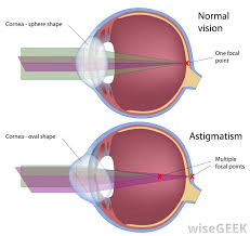 What Is Astigmatism With Pictures