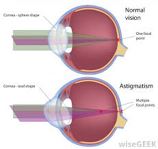 what is astigmatism with pictures