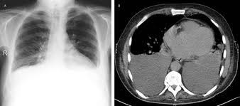In patients with symptomatic malignant pleural effusions with nonexpandable lung, failed pleurodesis, or loculated effusion, we suggest the use of ipcs over chemical pleurodesis. Comparative Interpretation Of Ct And Standard Radiography Of The Pleura