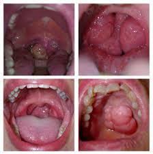 Ianya sering memberi petunjuk akan tumor gastrousus. Kanser Tekak Punca Simptom Dan Rawatan The Diagnosa
