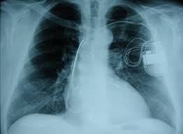 Röntgen (benannt nach dem physiker wilhelm conrad röntgen), auch röntgendiagnostik genannt, ist ein weit verbreitetes bildgebendes verfahren, bei dem ein körper unter verwendung eines röntgenstrahlers durchstrahlt wird. Kardiologie Herzschrittmacher Defibrillatoren Kardiale Resynchronisations Therapie