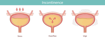 Image result for Stress Incontinence