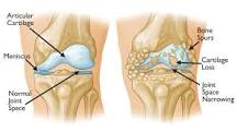 Image result for icd 10 code for degenerative arthritis right knee