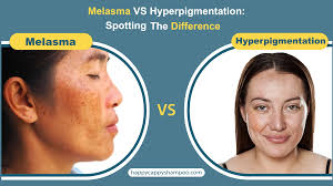Image result for Melasma