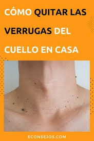 8 Formas Naturales Para Quitar Las Verrugas Del Cuello Como Quitar Verrugas Como Eliminar Las Verrugas Remedios Para Verrugas
