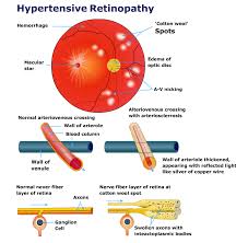 Maybe you would like to learn more about one of these? Hypertensive Retinopathy Ishwar Eye Centre