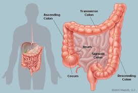 Image result for Diverticulitis