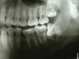 People on low income who have a community services card may be able to get free emergency dental care. Oral Maxillofacial Surgeons For Wisdom Teeth Removal