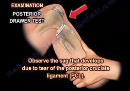 Image result for PCL Sag Test