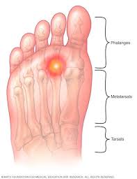 Metatarsalgia Metatarsalgia Treatment Foot Health Bruises Remedy