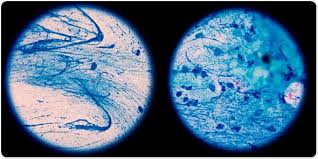 Mycobacterial Infections And Lady Windermere Syndrome
