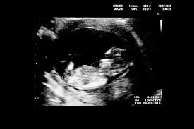 The most ideal time your dating scan is scan 8 to 12 weeks of pregnancy. 12 Week Pregnancy Dating Scan What Will It Tell Me Madeformums